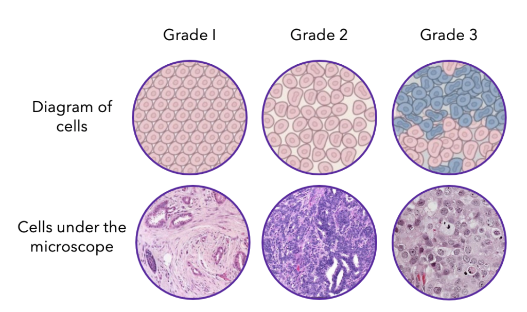 Understanding Your Pathology Report: Breast Cancer