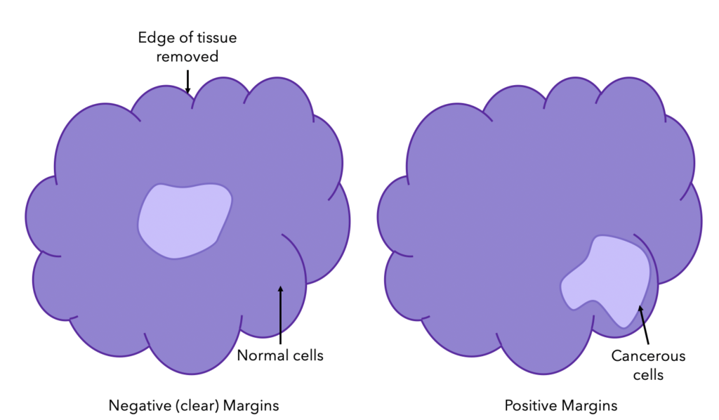 Breast Cancer Margins in the pathology report