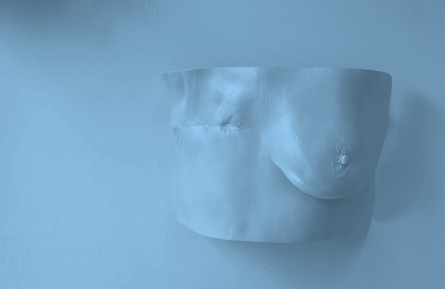 Mastectomy Cast