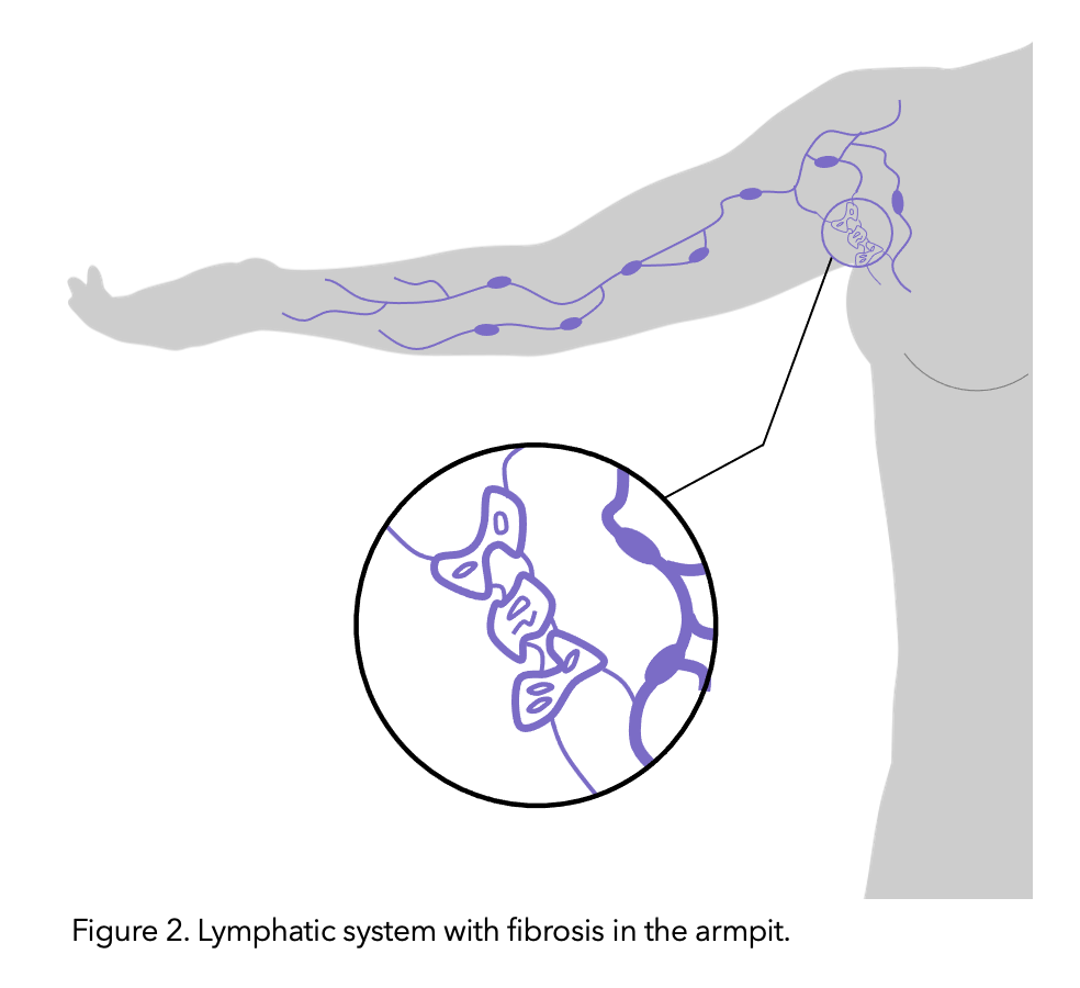 Remove Armpit Fat and Bra bulge in 14 Days with Oil Lymphatic Drainage  Massage 