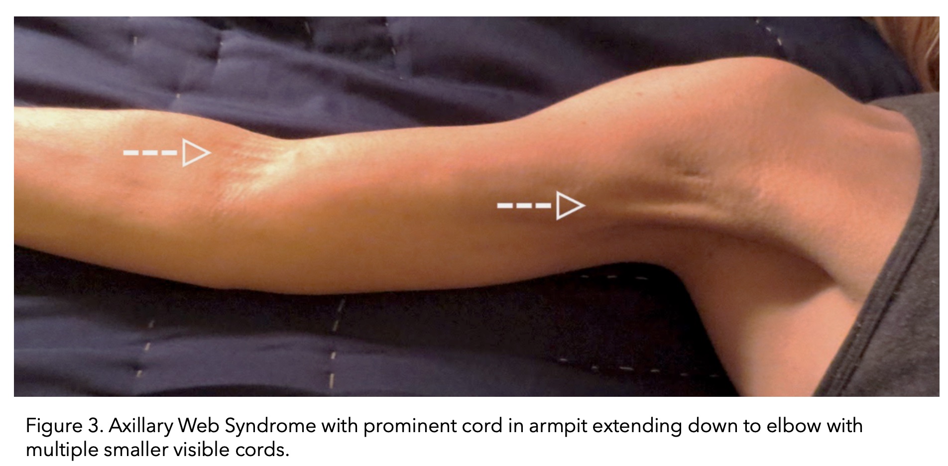 The Lymph Clinic - Axillary Web Syndrome or Cording. What is it? 🤔 This is  a condition that sometimes happens after breast cancer surgery, usually  after dissecting lymph nodes. Surgery may damage