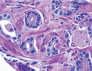 Biopsy image of a prostate tumour used in a prostate cancer diagnosis