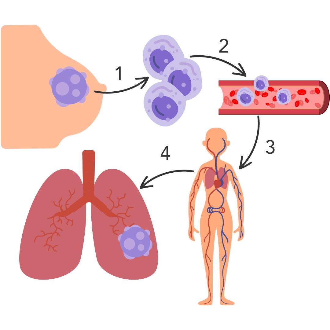 Diagram showing how cancer metastases are formed. The cancer cells break away from the primary tumour site and invade the nearby normal tissue  The cancer cells enter the blood or lymphatic system   The cancer cells travel through the blood or lymphatic vessels until they reach the target site, such as the bones, lungs, liver, brain etc.  Once at the target site, the cancer cells leave the blood or lymphatic vessels and start to grow, forming secondary tumours.  