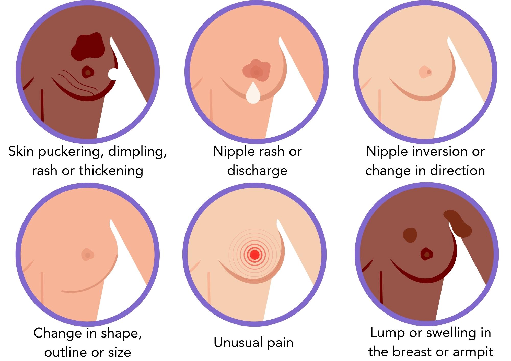 Key signs of breast cancer to look out for